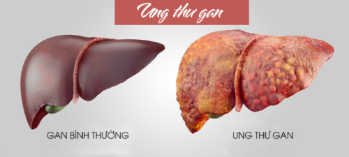 Ung thư gan là gì? Ung thư gan có chữa được không? TÌM HIỂU NGAY