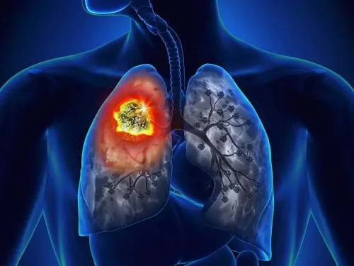 Fucoidan điều trị ung thư phổi được không? CLICK XEM NGAY