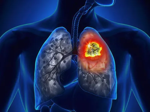 Ung thư phổi và những điều cần biết! XEM NGAY