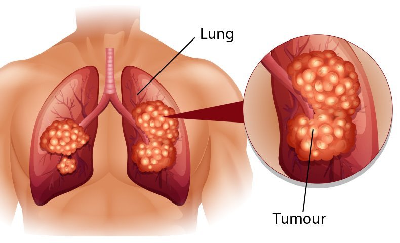 Hình ảnh ung thư phổi tế bào nhỏ