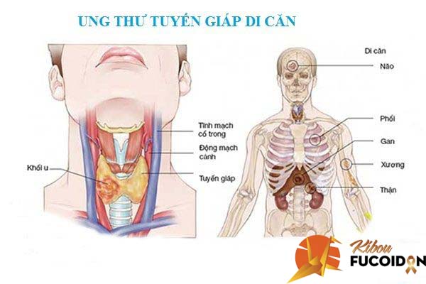 Nghệ Đen Chống Di Căn Hiệu Quả Trong Kibou Fucoidan !! nghe-den-chong-di-can-te-bao-ung-thu