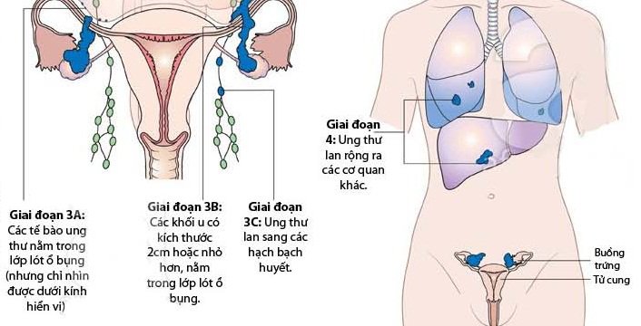 Tổng Quan Căn Bệnh Ung Thư Buồng Trứng Tổng Quan Căn Bệnh Ung Thư Buồng Trứng