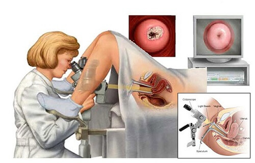 Tổng Quan Những Điều Nên Biết Về Bệnh “ Ung Thư Cổ Tử Cung” ung-thu-co-tu-cung
