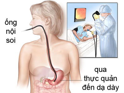 Tổng Quan Bệnh Ung Thư Dạ Dày: 10 Người Bệnh Thì 5-6 Người Mắc Phải ung-thu-da-day-phuong-phap-chan-doan