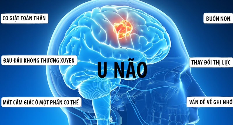 Tổng Quan Về Căn Bệnh Ung Thư Não bieu-hien-ung-thu-nao