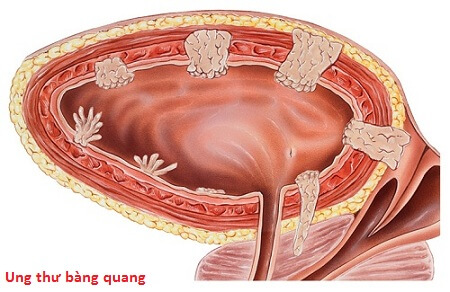 Tổng Quan Bệnh Ung Thư Bàng Quang tong-quan-ung-thu-bang-quang-giai-doan