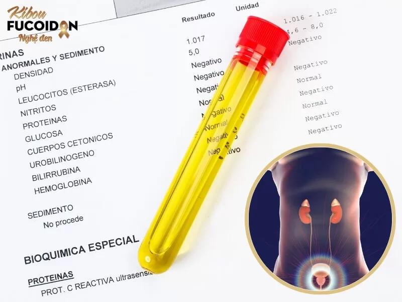 Tổng Quan Bệnh Ung Thư Bàng Quang Xét nghiệm nước tiểu để chẩn đoán ung thư bàng quang