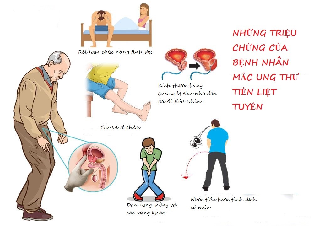Những Điều Nam Giới Nên Biết Về Ung Thư Tiền Liệt Tuyến tong-quan-ung-thu-tien-liet-tuyen