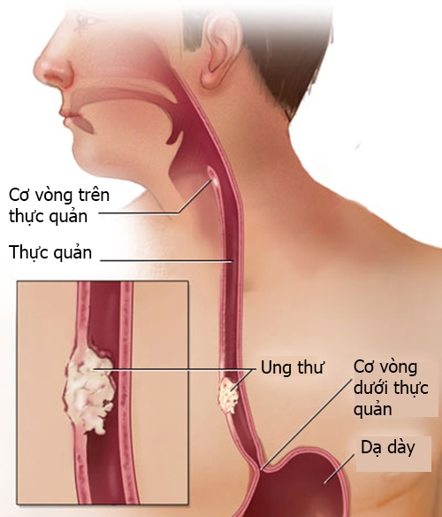 tong-quan-ung-thu-thuc-quan