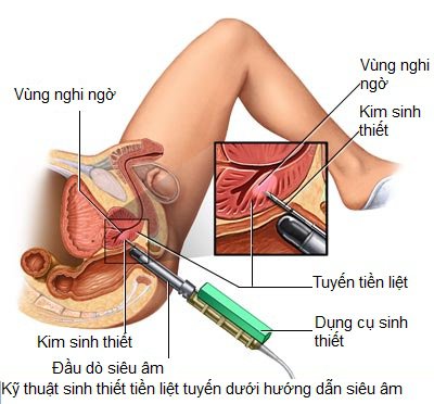 Những Điều Nam Giới Nên Biết Về Ung Thư Tiền Liệt Tuyến tong-quan-ung-thu-tien-liet-tuyen-phuong-phap-chan-doan