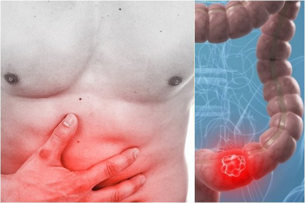 Tổng Quan Ung Thư Ruột 1 Cách Gọi Khác Của Ung Thư Đại Trực Tràng Kiến Thức Đầy Đủ Nhất Về Bệnh tong-quan-ung-thu-ruot-dau-hieu
