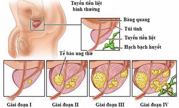 Những Điều Nam Giới Nên Biết Về Ung Thư Tiền Liệt Tuyến tong-quan-ung-thu-tien-liet-tuyen-cac-giai-doan
