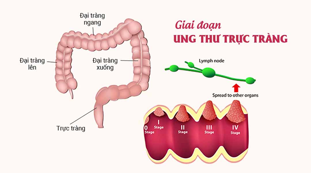 Tổng Quan Ung Thư Ruột 1 Cách Gọi Khác Của Ung Thư Đại Trực Tràng Kiến Thức Đầy Đủ Nhất Về Bệnh tong-quan-ung-thu-ruot-hay-ung-thu-dai-trang