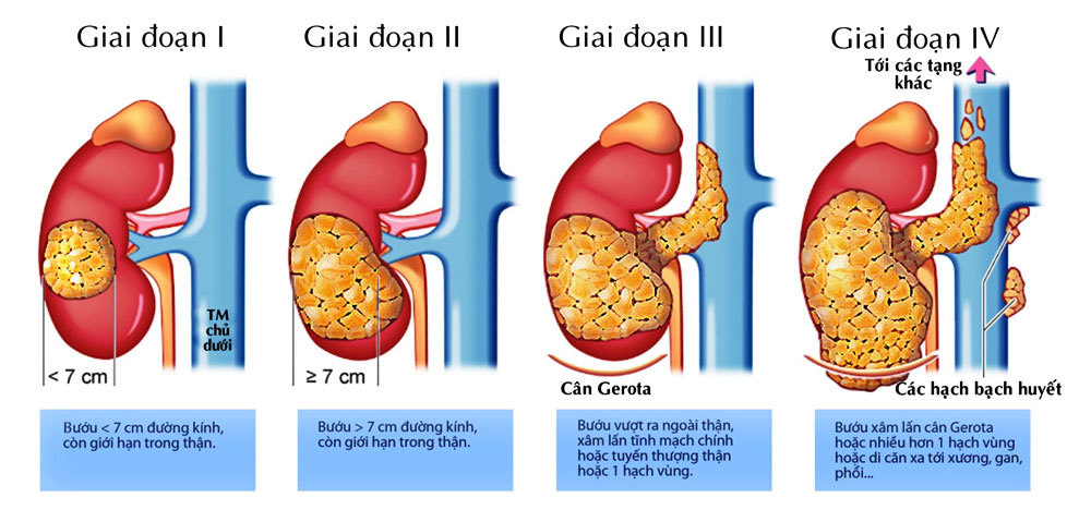 Tổng Quan Bệnh Ung Thư Thận Nhiều Người Chưa Biết tong-quan-benh-ung-thu-than