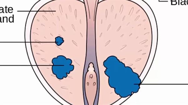 Những Điều Nam Giới Nên Biết Về Ung Thư Tiền Liệt Tuyến tong-quan-nguyen-nhan-dan-den-ung-thu-liet-tuyen