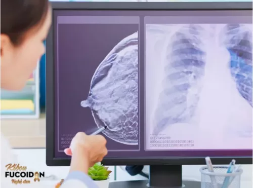 UNG THƯ VÚ GIAI ĐOẠN 2 CHỮA ĐƯỢC KHÔNG?