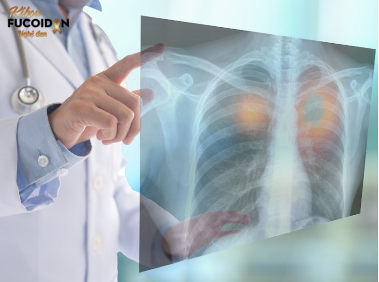 Ung thư phổi giai đoạn đầu có tỷ lệ chữa khỏi khá cao