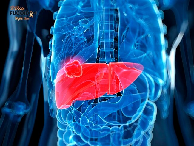 Ung thư phổi giai đoạn 4 có phải là dấu chấm hết? Tế bào ung thư di căn tới gan