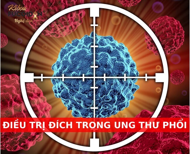 Ung thư phổi giai đoạn 4 có phải là dấu chấm hết? Thuốc điều trị ung thư phổi giai đoạn cuối