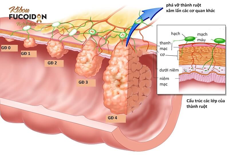 Những thông tin cần biết về ung thư đại tràng giai đoạn cuối Các giai đoạn của ung thư đại tràng