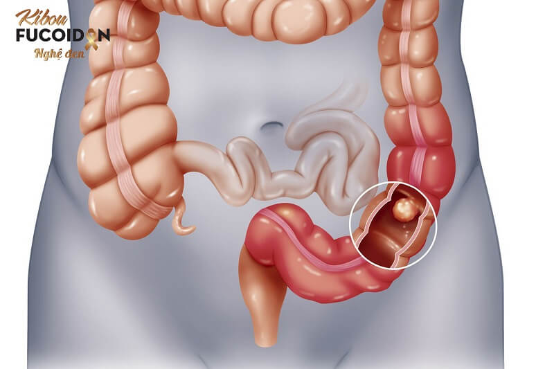 Từ A tới Z về phương pháp mổ ung thư đại tràng Mổ ung thư đại tràng