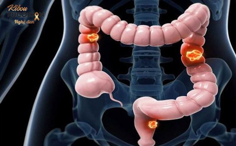 Những thông tin cần biết về ung thư đại tràng giai đoạn cuối Ung thư đại tràng giai đoạn cuối