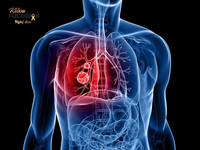 Ung thư phổi giai đoạn 4 có phải là dấu chấm hết? Ung thư phổi giai đoạn 4