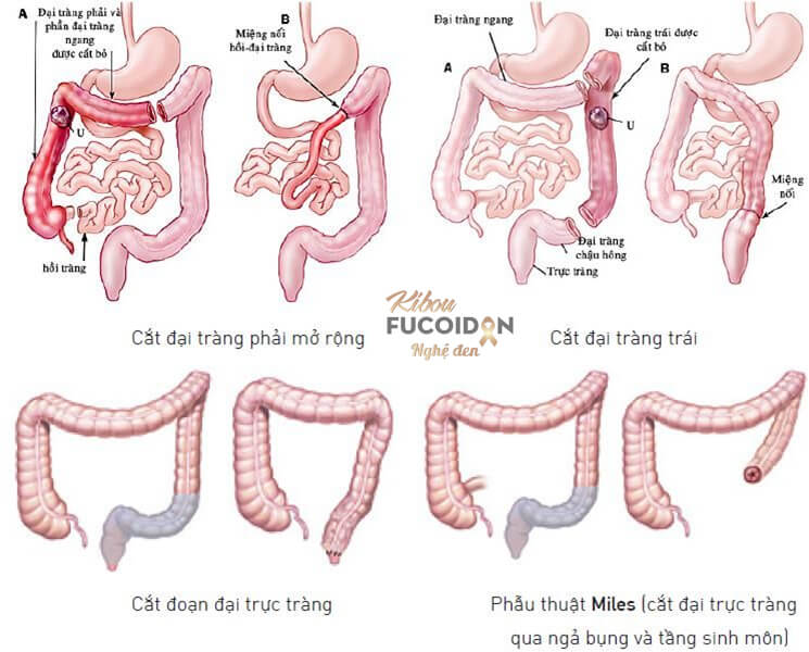 Từ A tới Z về phương pháp mổ ung thư đại tràng Các kỹ thuật cắt ung thư đại tràng