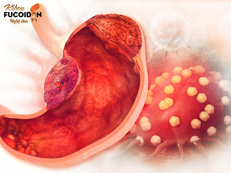 Ung thư dạ dày giai đoạn 3 dấu hiệu và cách điều trị