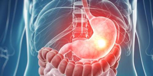 Ung thư dạ dày giai đoạn đầu - Nhận biết và điều trị kịp thời