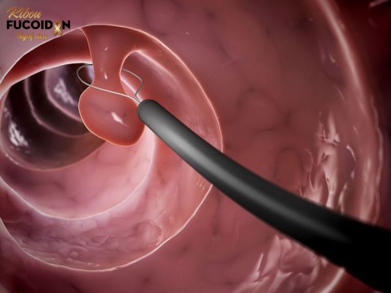 Polyp dạ dày và những biến chứng không ngờ Cắt Polyp dạ dày