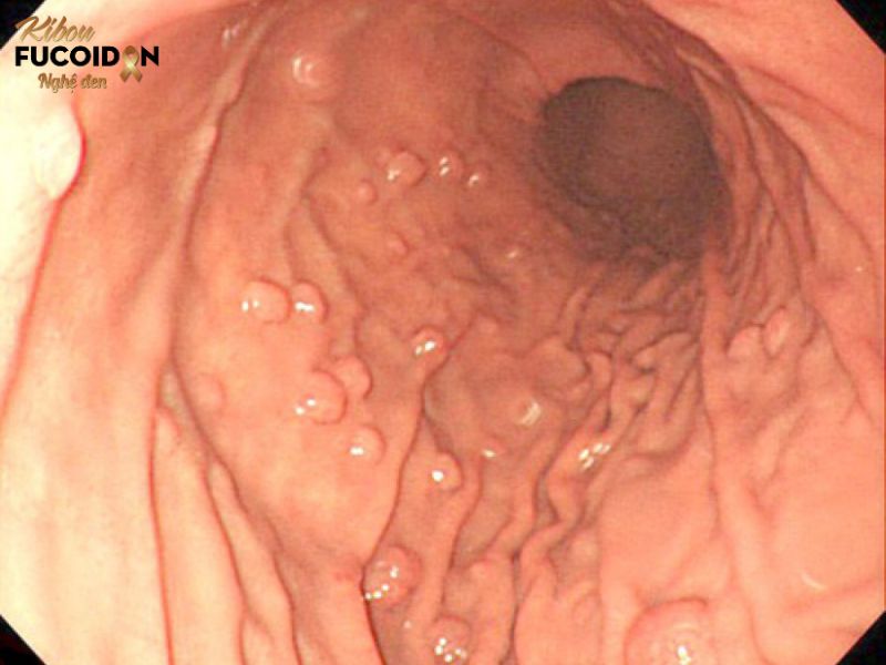 Polyp dạ dày và những biến chứng không ngờ Hình ảnh Polyp dạ dày
