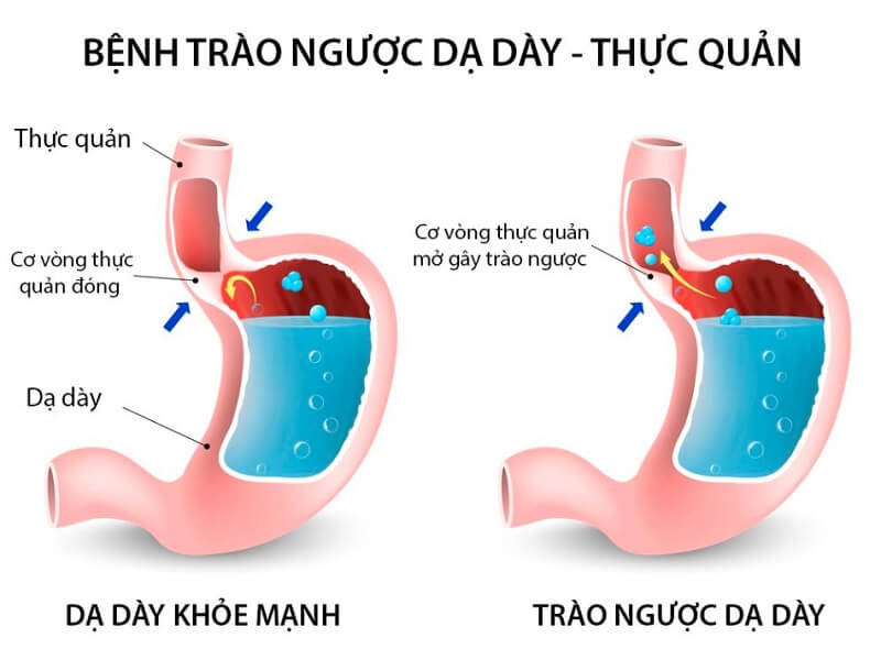 Giải mã triệu chứng Ợ hơi - chua, nóng liên tục Trào ngược dạ dày thực quản