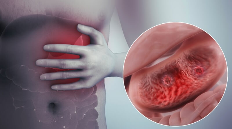 Viêm loét dạ dày gây ung thư - Biến chứng nguy hiểm bạn nên biết Viêm loét dạ dày có gây ung thư dạ dày?