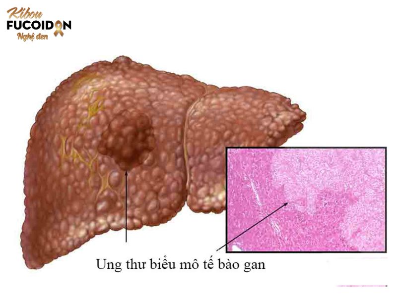 Ung thư biểu mô tế bào gan: Nguyên nhân, dấu hiệu và điều trị Ung thư biểu mô tế bào gan