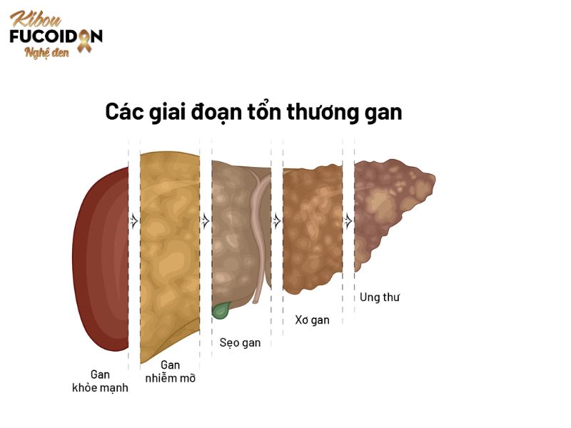Điểm danh các loại ung thư gan Ung thư gan tái phát