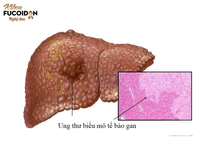Điểm danh các loại ung thư gan Ung thư biểu mô tế bào gan - một trong các loại ung thư gan phổ biến