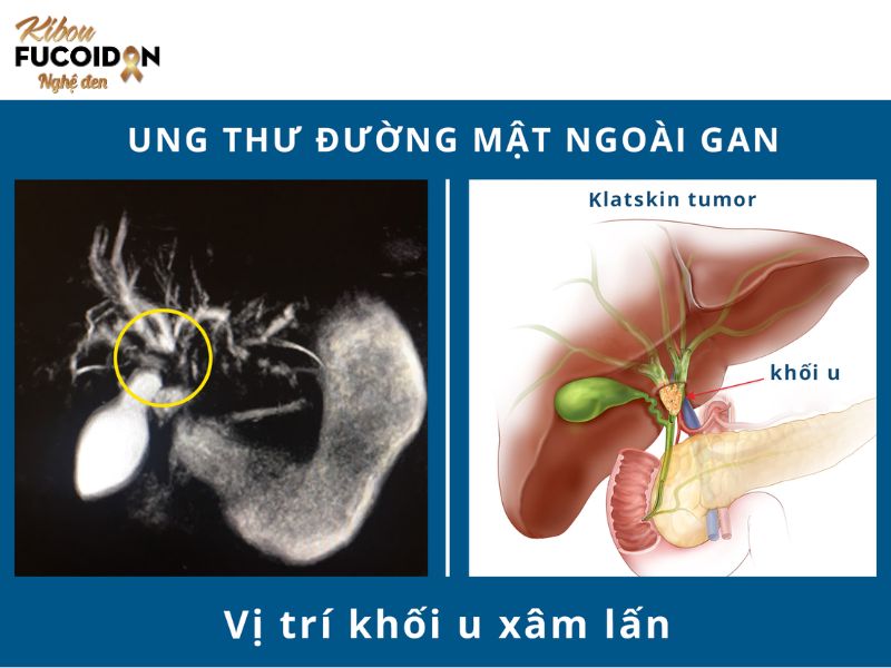 Điểm danh các loại ung thư gan Ung thư đường mật trong gan