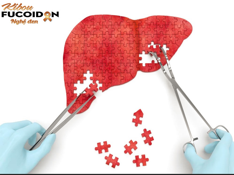 Phác đồ điều trị ung thư gan có thể gồm nhiều phương pháp.