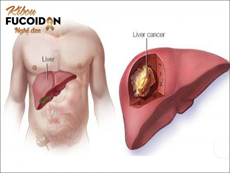 Hình ảnh khối u gan ác tính ở bệnh nhân ung thư