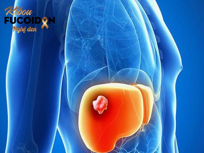 Khối u gan bị vỡ: Nguyên nhân và cách xử trí Hình ảnh khối u ung thư gan