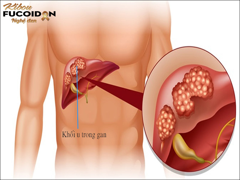 11 phương pháp điều trị ung thư gan phổ biến hiện nay Hình ảnh khối u ung thư gan