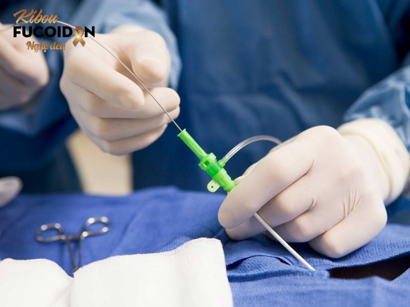 Bác sĩ thực hiện đốt sóng cao tần ung thư gan 