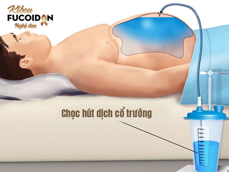 Hút dịch ung thư gan: Chỉ định và quy trình thực hiện Hút dịch ung thư gan