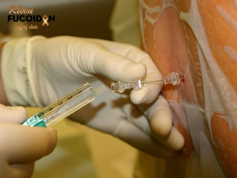 Hút dịch ung thư gan: Chỉ định và quy trình thực hiện Hút dịch ung thư gan