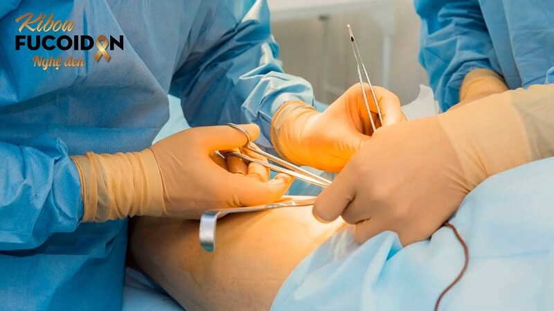 Ung thư gan tái phát: Nguyên nhân, điều trị và cách phòng ngừa Phẫu thuật