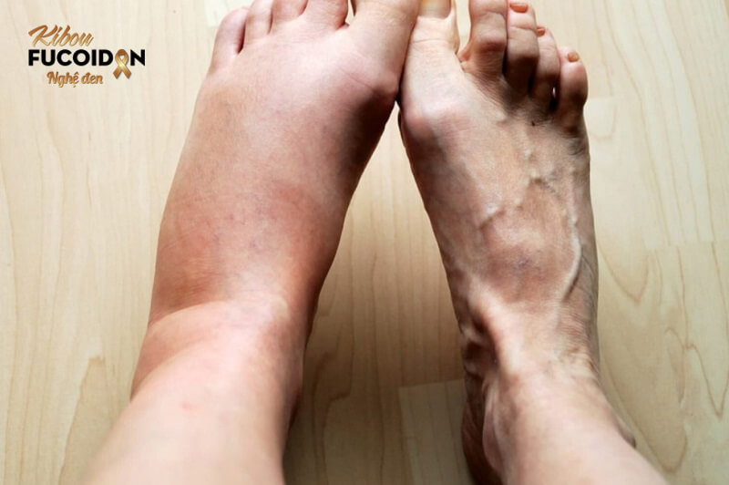 Ung thư dạ dày di căn gan. Nhận biết và điều trị Phù chân và tay