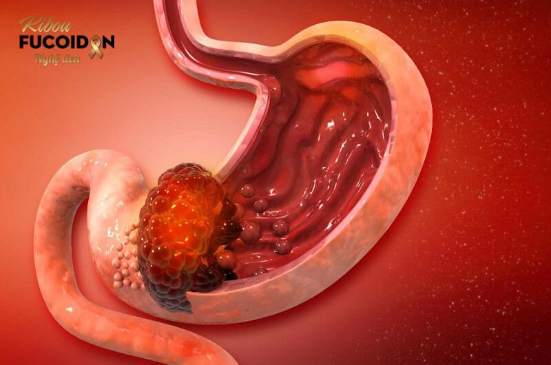Ung thư dạ dày di căn gan. Nhận biết và điều trị Ung thư dạ dày di căn gan