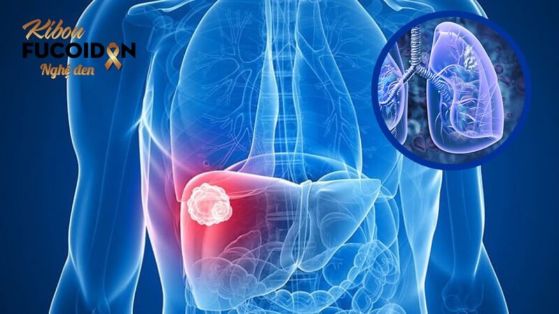 Quá trình ung thư gan di căn phổi và cách đối phó Ung thư gan di căn phổi