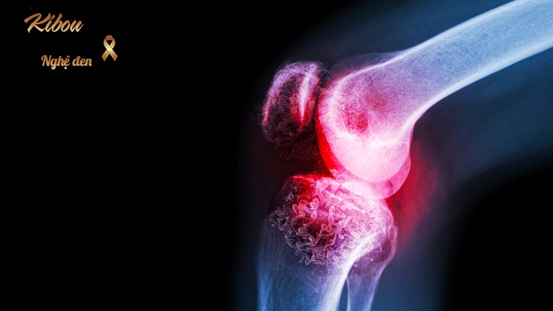 Ung thư gan di căn: Cơ chế, nhận biết và điều trị Ung thư gan di căn xương